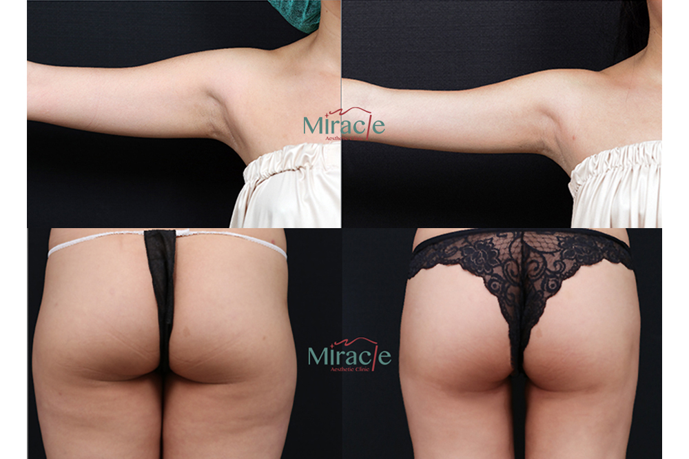 透過威塑脂雕打造肌肉線條