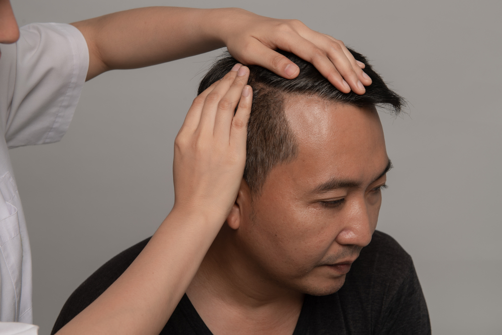 台中植髮推薦哪種手術?FUT、FUE、ARTAS三種手術效果比較一次告訴你