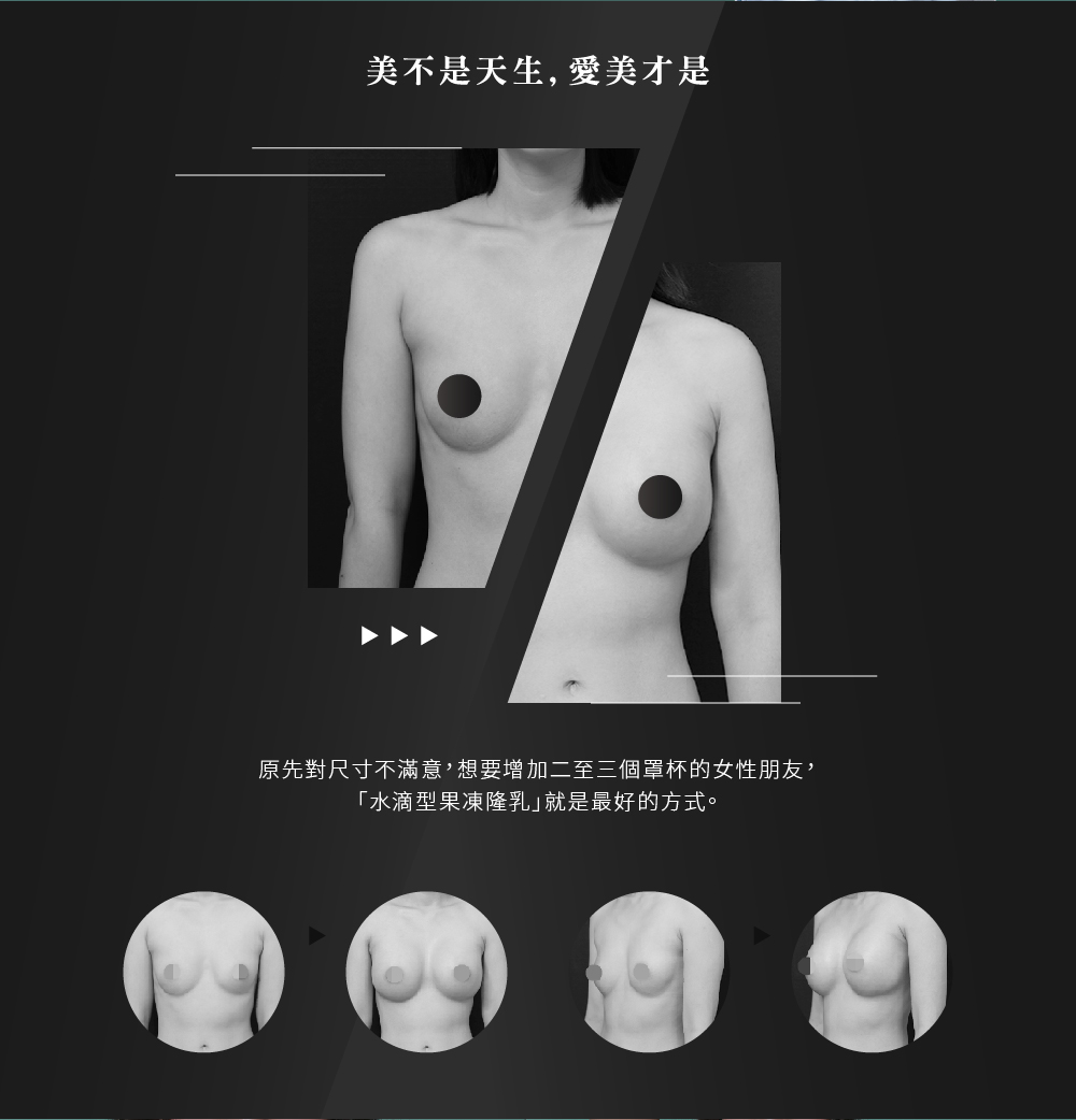 水滴隆乳案例