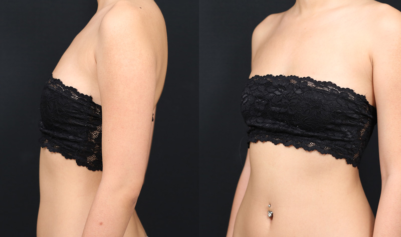 自體脂肪轉移豐胸隆乳:女孩大腿抽脂轉移勇敢蛻變