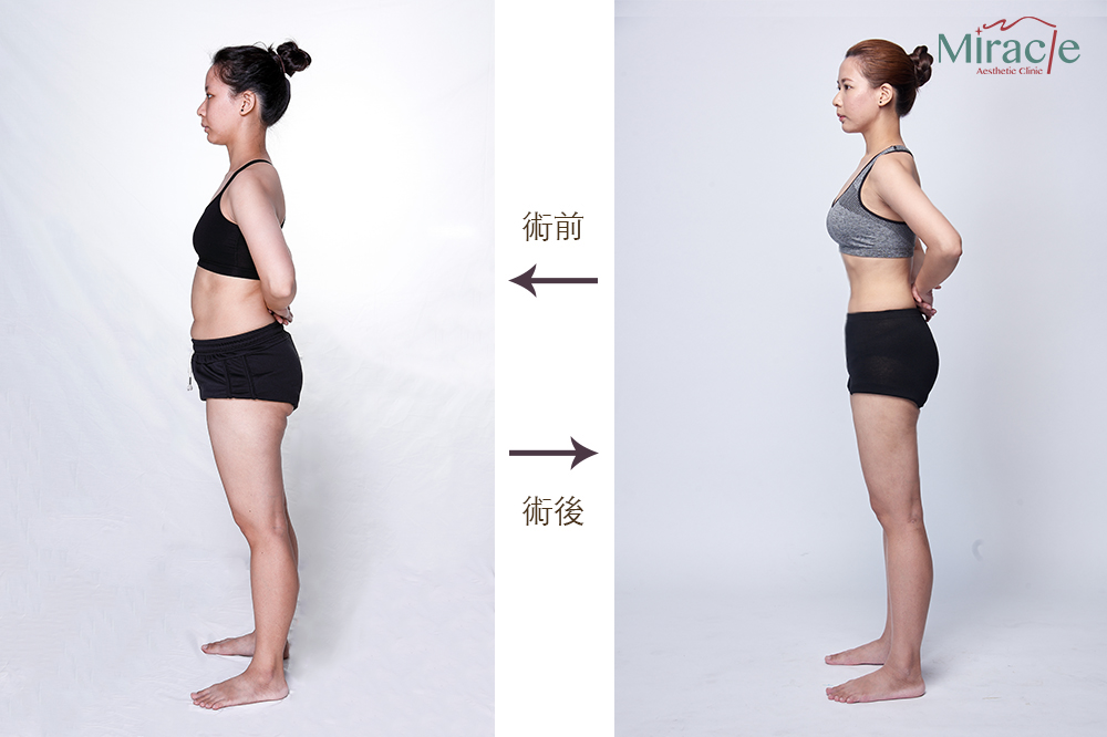 使用威塑2.2代進行大腿抽脂