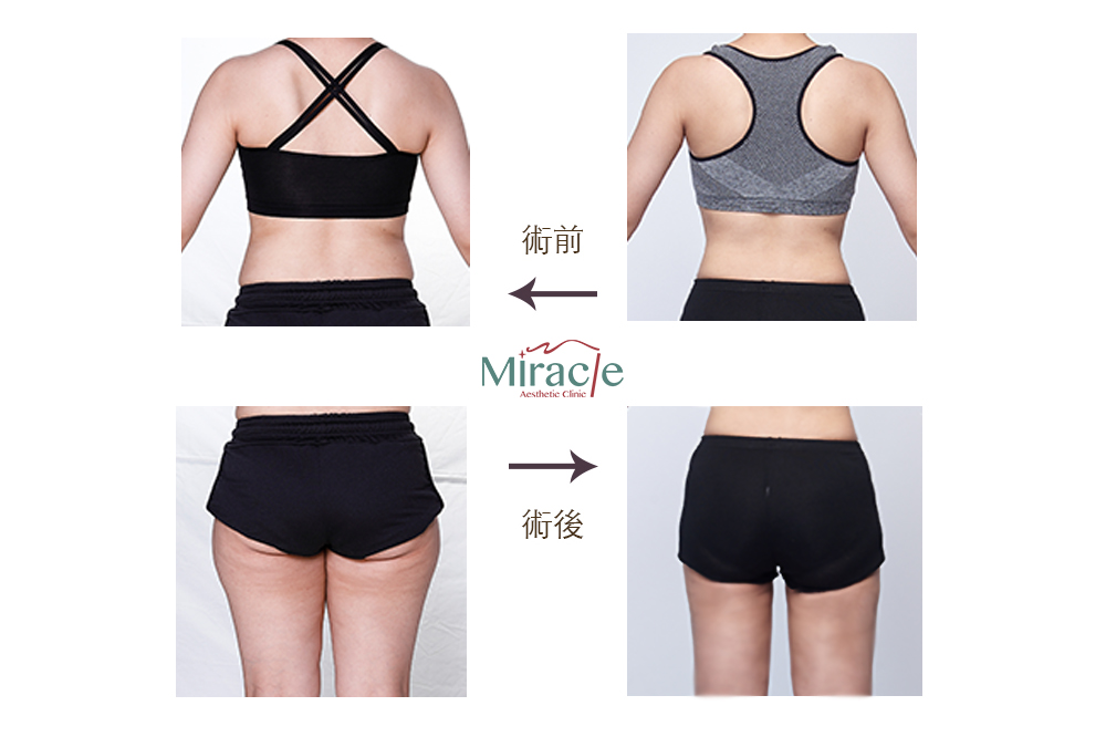 透過威塑脂雕（VASER 4D）做到「凸顯」以及「雕塑」出理想的身體曲線