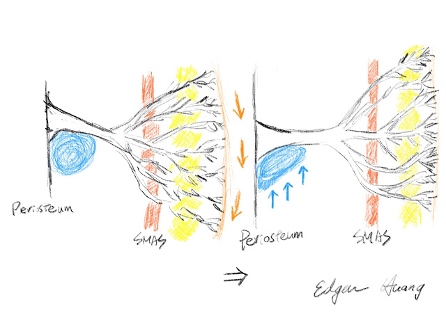 玻尿酸True Lift真性韌帶拉皮,臉型下垂拉提免動刀!