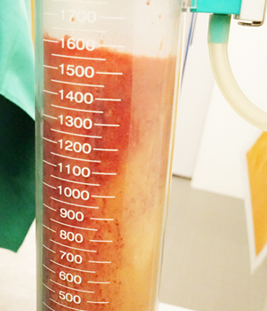 威塑脂雕心得,威塑抽脂心得,威塑抽脂案例