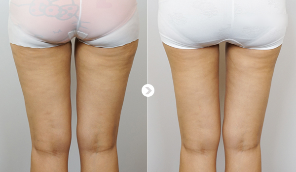 威塑脂雕心得,威塑抽脂心得,威塑抽脂案例