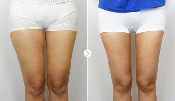 威塑脂雕心得,威塑抽脂心得,威塑抽脂案例