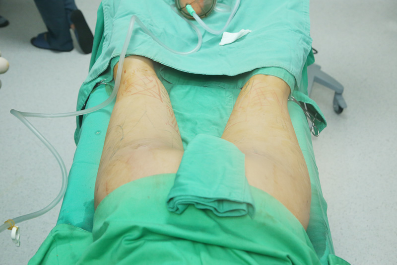 自體脂肪轉移豐胸隆乳:女孩大腿抽脂轉移勇敢蛻變