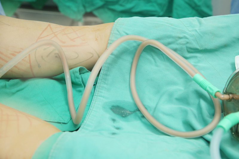 自體脂肪轉移豐胸隆乳:女孩大腿抽脂轉移勇敢蛻變