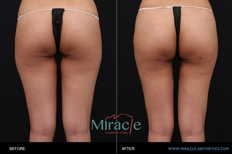 自體脂肪轉移豐胸隆乳:女孩大腿抽脂轉移勇敢蛻變