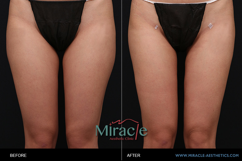 自體脂肪轉移豐胸隆乳:女孩大腿抽脂轉移勇敢蛻變