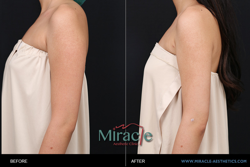 自體脂肪轉移豐胸隆乳:女孩大腿抽脂轉移勇敢蛻變