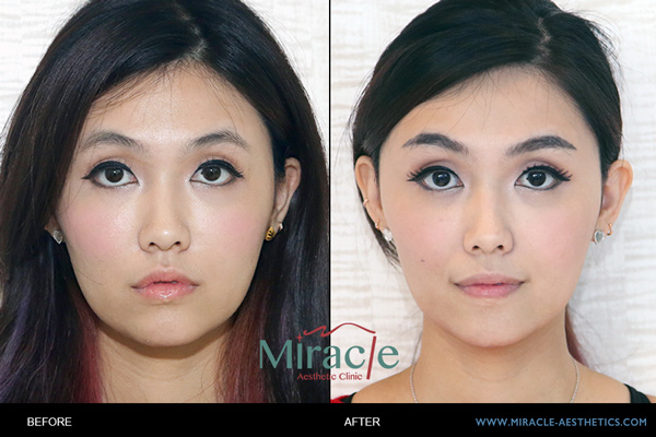 嘴邊肉埋線拉提心得｜藝人張喬菲嘴邊肉手術分享