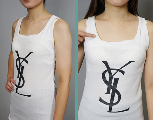 打造水滴乳,術前評估很重要