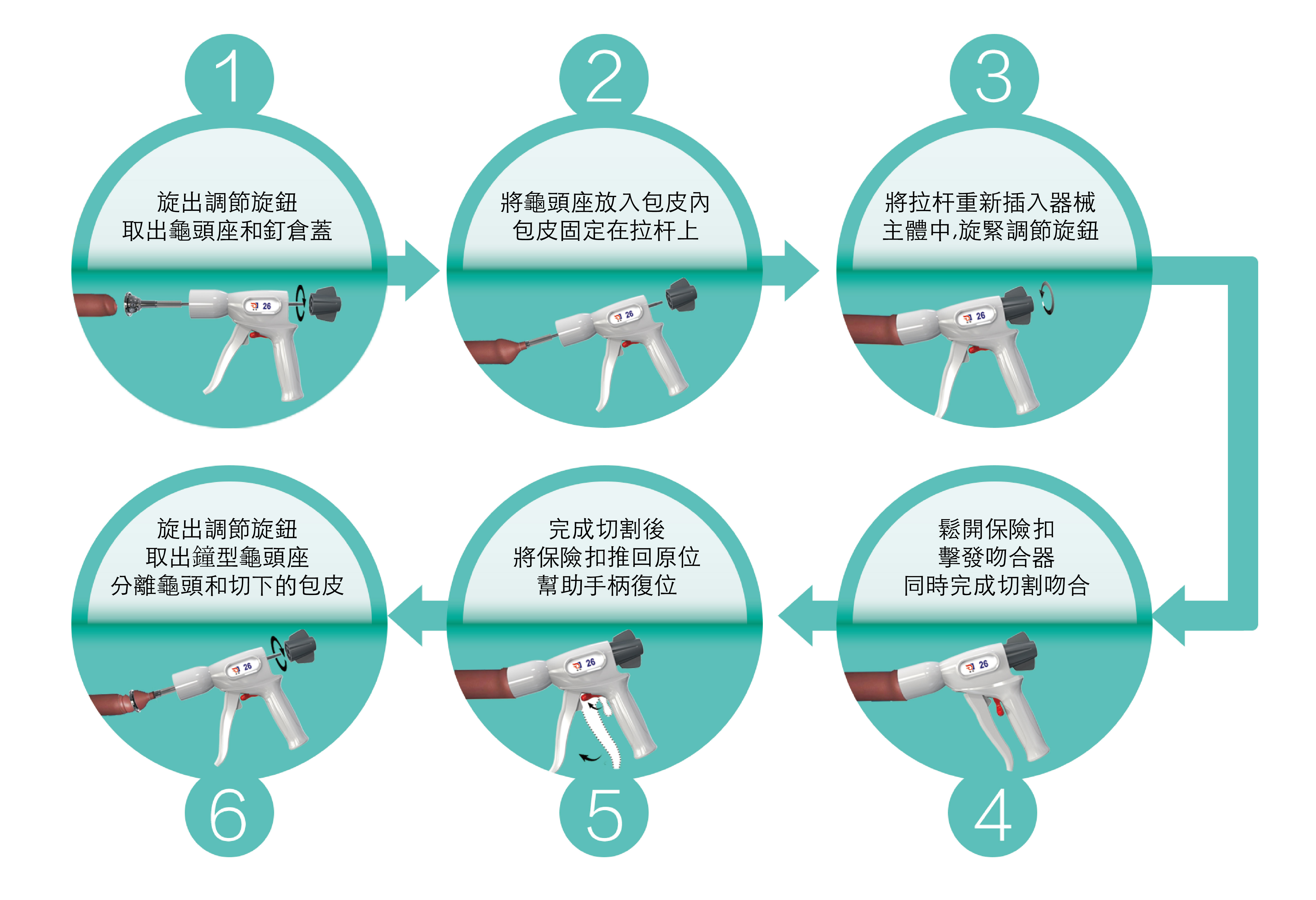 包皮槍手術操作流程如下