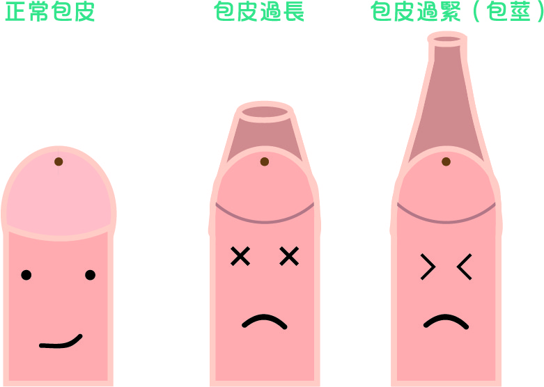 進行包皮槍手術前，先來了解什麼是包皮過長與包莖
