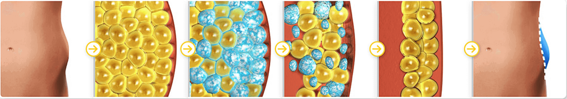 冷凍溶脂讓你輕鬆減脂｜不用動手術就能快速減脂？