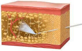 水刀抽脂介紹｜水刀抽脂費用怎麼算？