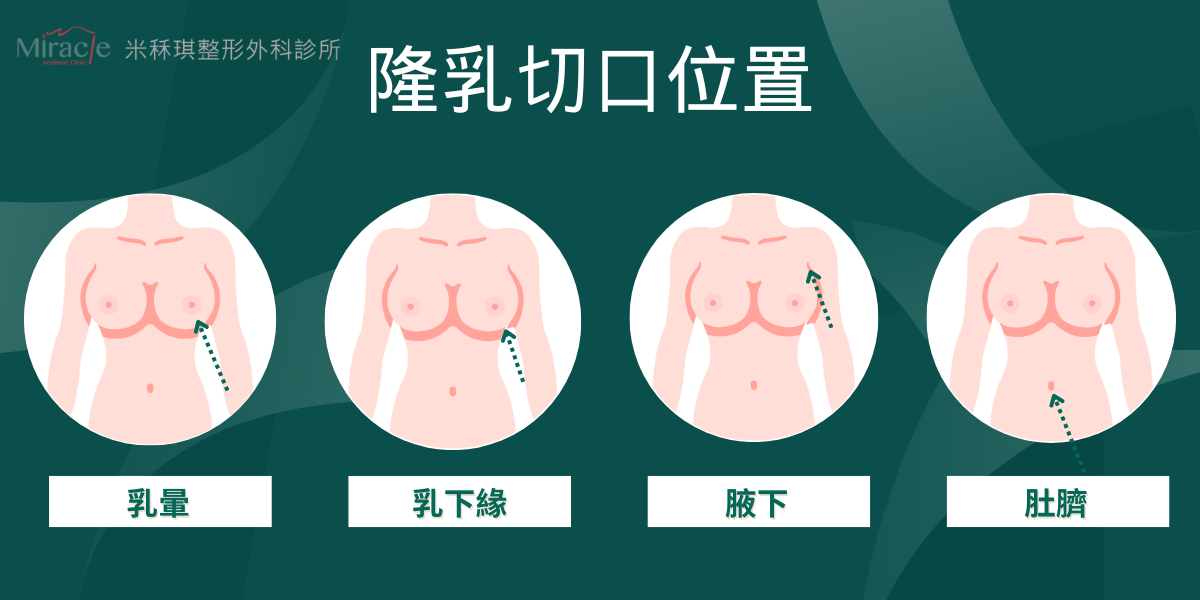 隆乳手術切口方式